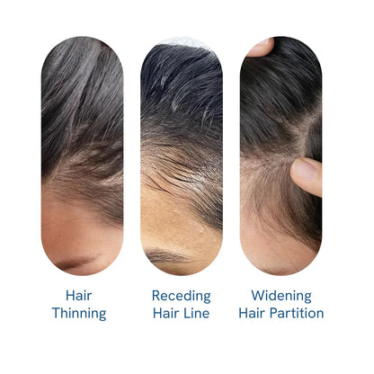 Be Bodywise Advanced Hair Growth Roll-On Serum | 3% Rosemary | 2% Aminexil | 3% Redensy l 2% Anagain | Precision Scalp Applicator | Paraben & Sulphate Free | Non oily and mess free-HHW